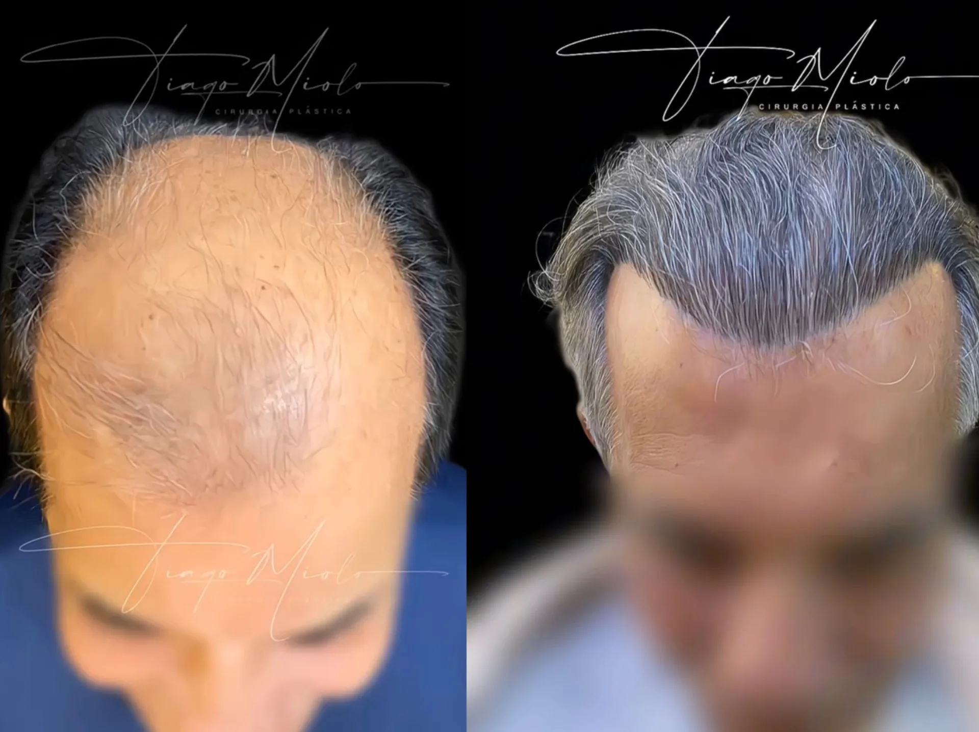 Resultado de Técnica FUE DHI - 12 meses - Transplante Capilar ALLFIOS