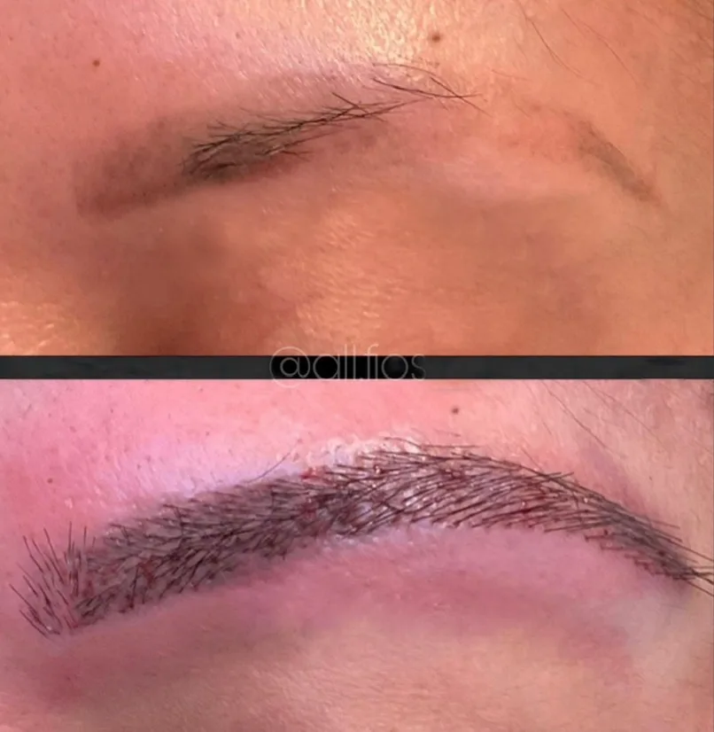 Resultado de Transplante de Sobrancelha - Pós Imediato - Transplante Capilar ALLFIOS